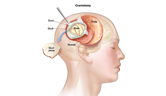 Understanding the Prognosis of Brain Tumors – What Every Patient and Family Should Know