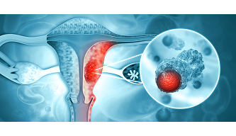 Ovarian Cancer – The Whispering Disease Every Woman Should Know About