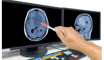 Understanding Meningioma: Symptoms, Diagnosis & Treatment of a Common Brain Tumor
