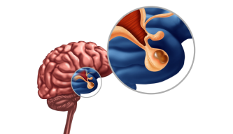 Understanding Pituitary Tumors: Hormones, Symptoms & Treatment Options