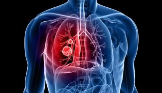Lung Cancer: Breathing New Hope with Early Detection and Advanced Care