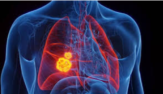 Surgery for Lung Cancer: Removing Cancer, Restoring Hope