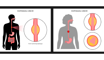 Oesophagus Cancer – When Swallowing Becomes a Warning Sign
