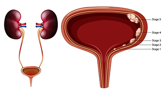 Bladder Cancer – Listen to the Signs Before It’s Too Late