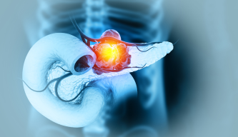 Pancreatic Cancer – Understanding a Silent but Serious Disease