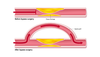 Coronary Artery Bypass Grafting (CABG): A New Pathway to a Healthier Heart